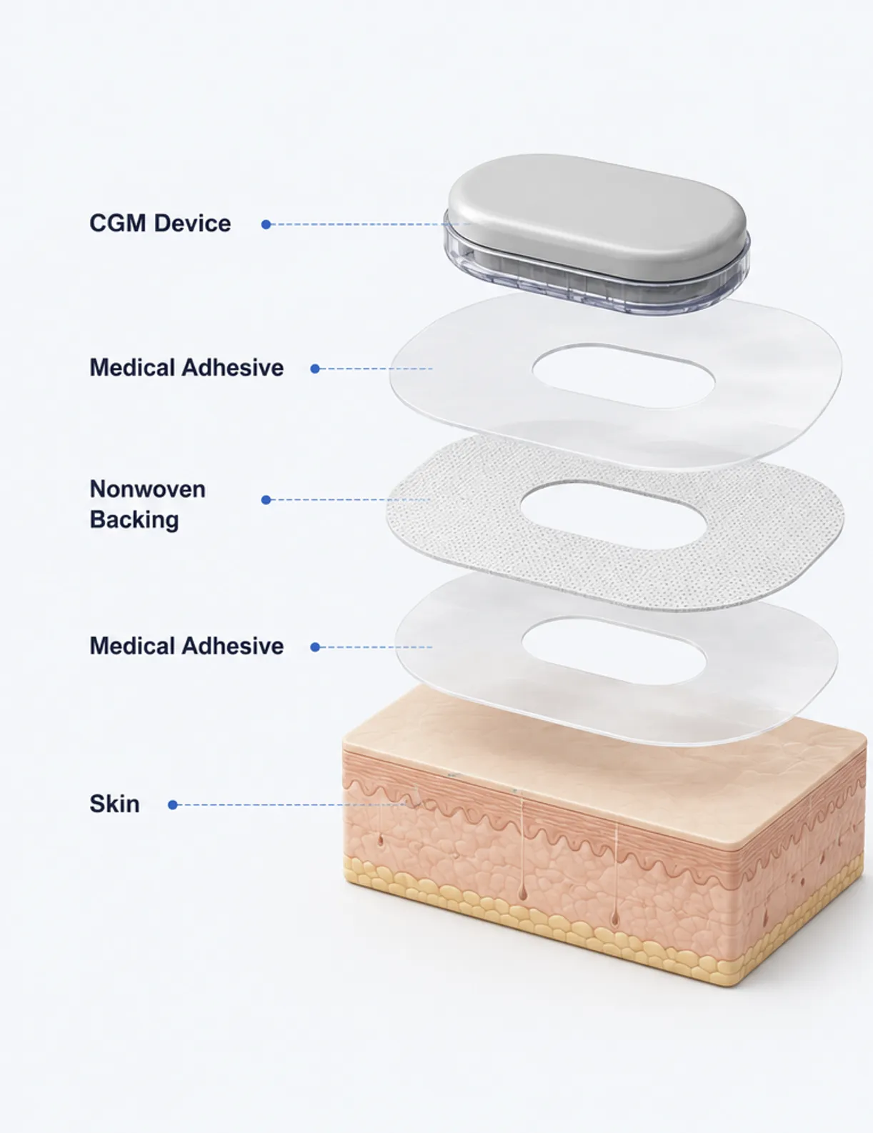 Exploded CGM device, medical adhesive, nonwoven backing, and skin layers